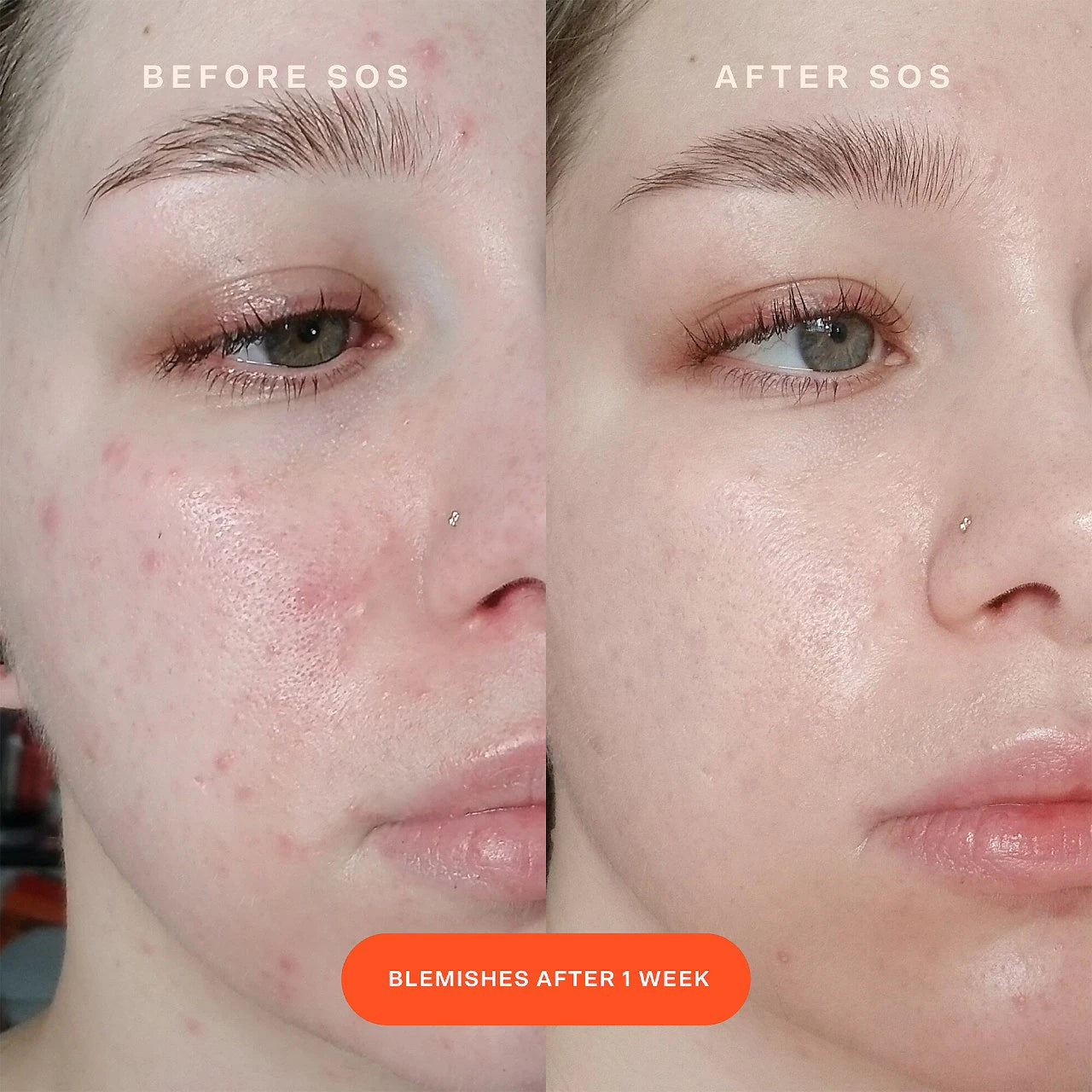 PRE ORDER-SOS Intensive Redness Relief Serum with Hypochlorous Acid