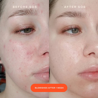 PRE ORDER-SOS Intensive Redness Relief Serum with Hypochlorous Acid