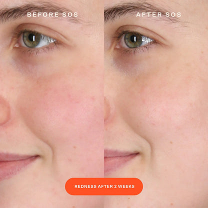 PRE ORDER-SOS Intensive Redness Relief Serum with Hypochlorous Acid